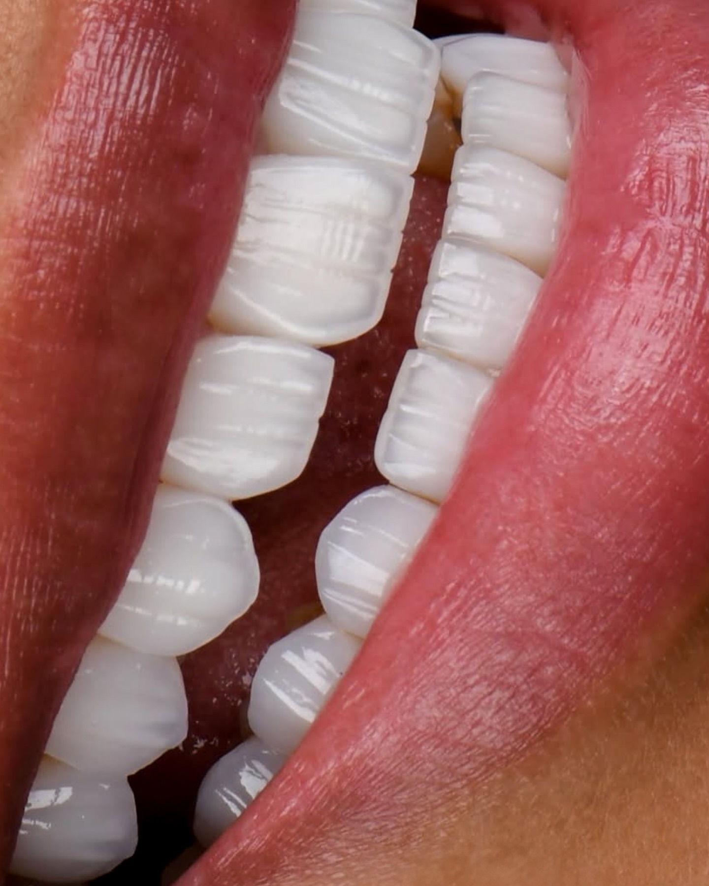 Dental restoration process